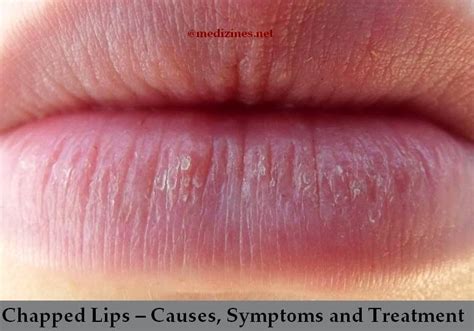 Chapped Lips – Causes, Symptoms and Treatment