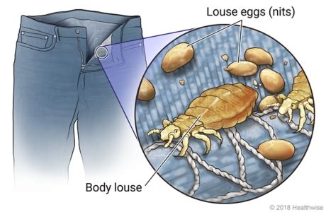 Body lice | SaskHealthAuthority