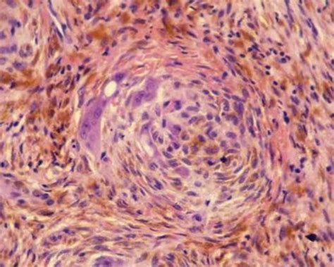 Non-Ossifying Fibroma - Pathology - Orthobullets