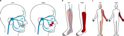 Allodynia and hyperalgesia in neuropathic pain: clinical manifestations ...