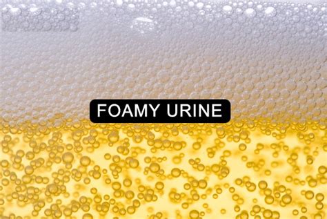 Foamy Urine: Causes, Picture, Symptoms And Treatment