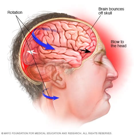 Chronic traumatic encephalopathy Disease Reference Guide - Drugs.com