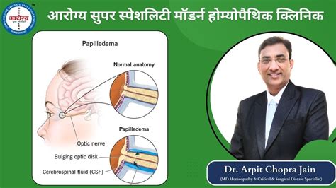 Papilledema treatment at Dr. Arpit Chopra Jain's Aarogya Super Speciality Modern Homeopathy ...