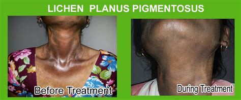 Lichen Planus Pigmentosus LPP Ayurvedic Treatment in India