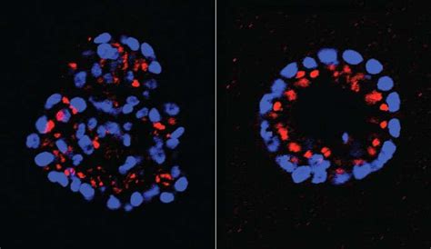 New signaling pathway discovered in HER2-positive breast cancer, and two powerful drug targets