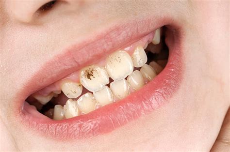 Rotten Teeth Pictures, Images and Stock Photos - iStock