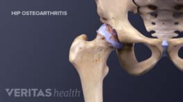 Facet Joint Osteoarthritis