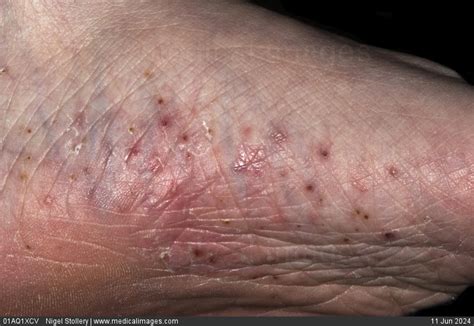 STOCK IMAGE, dermatology plantar pustular psoriasis multiple red and ...