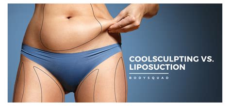 CoolSculpting vs. Liposuction - The Body Squad