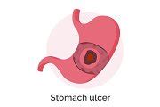 Stomach Ulcer, Gastric Illness and | Healthcare Illustrations ~ Creative Market