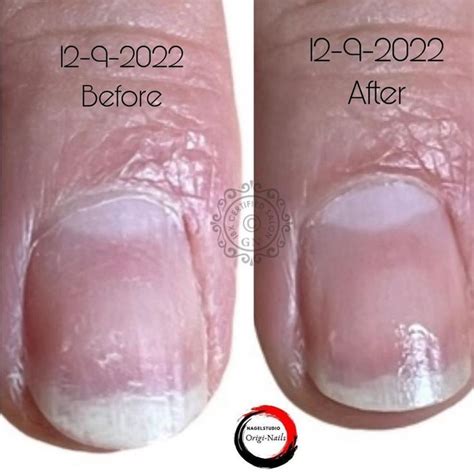 Before and After | Nail growth treatment, Nail strengthener, Natural nails