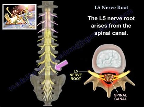 L5 Nerve Root - Everything You Need To Know - Dr. Nabil Ebraheim - YouTube