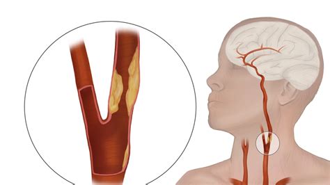 Carotid Artery Stenosis Ultrasound Diagnosis - SONOSIF - by SIFSOF ...