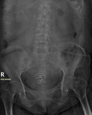 Medical devices in the abdomen and pelvis | Radiology Reference Article | Radiopaedia.org