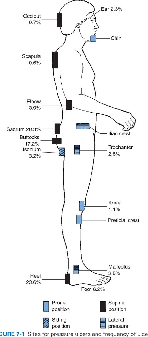 Pressure Ulcer Body Map