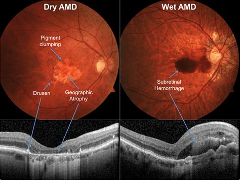 Macular Degeneration - Prompt Treatment | myeyespecialist