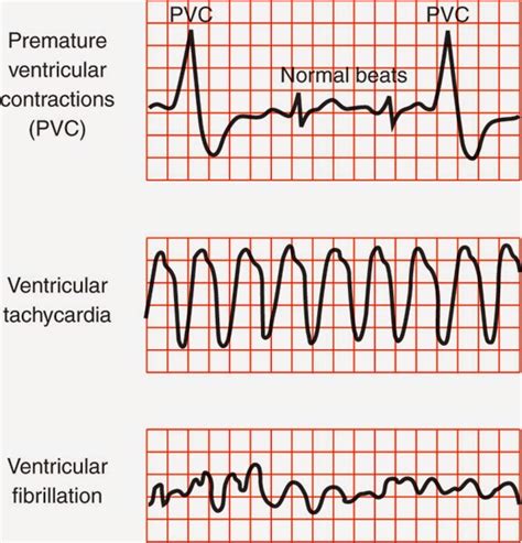 Premature Ventricular Complex - Medical School Memoirs