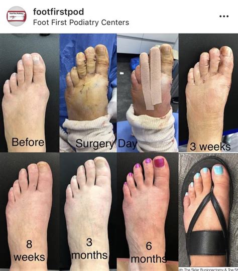 Worth the Results! 👣💥 | Hammer toe surgery, Podiatry, Hand foot and mouth