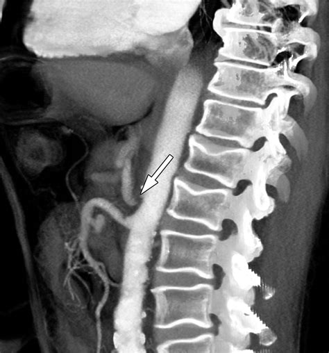 Median Arcuate Ligament Syndrome: Evaluation with CT Angiography | RadioGraphics