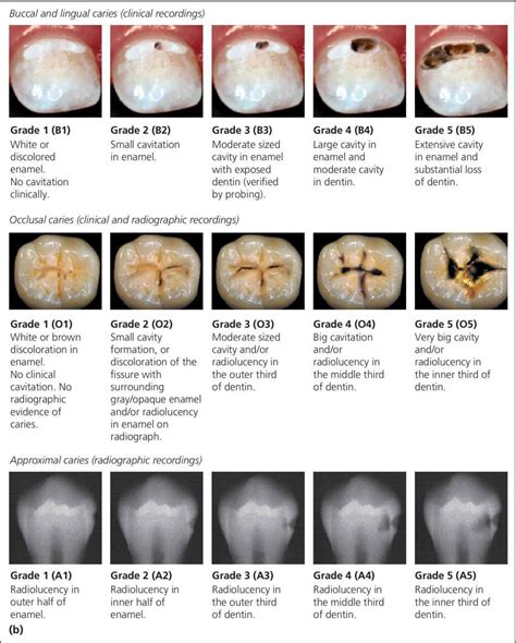 12: Diagnosis and Management of Dental Caries | Pocket Dentistry