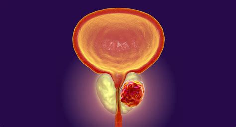 Prostate cancer treatment side effects vary | MD Anderson Cancer Center