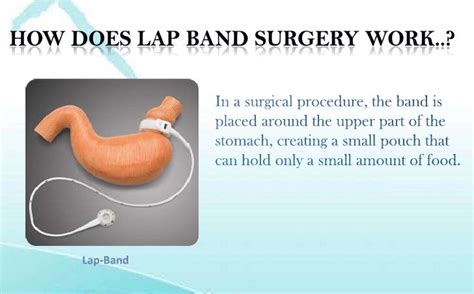 Lap band surgery mexico