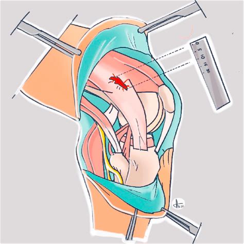 Identification and measurement of posterolateral knee iatrogenic injury ...