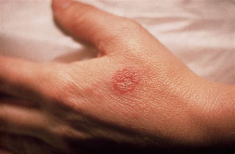 Discoid Eczema: 10 Symptoms Of Discoid Eczema