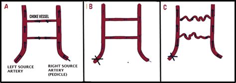 Sequence of events with alteration in blood flow in a vascular... | Download Scientific Diagram