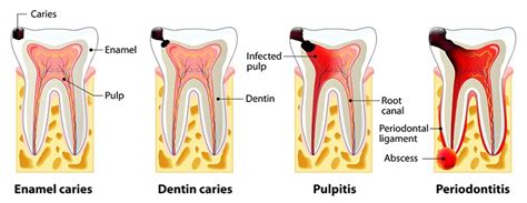 How Long Does Root Canal Take To Heal | Did you know this about