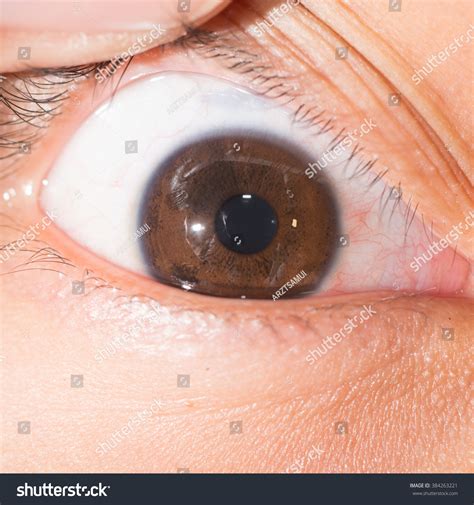 Close Up Of The Iris Nodule During Eye Examination. Stock Photo 384263221 : Shutterstock