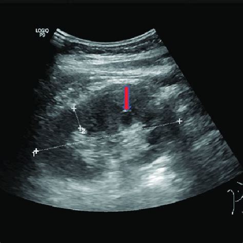 1 Ultrasound image of the left kidney pre-biopsy. There was a renal... | Download Scientific Diagram