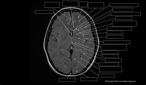 Approach to MRI brain | LearningNeurology.com