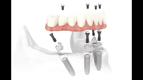 Dental Implant Osseointegration Process - YouTube