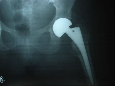 4) Fig 4.Post operative radiograph after hemiarthroplasty | Download ...