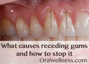 What causes receding gums and how to stop it - OraWellness