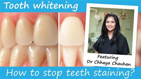 How to stop teeth from staining - YouTube