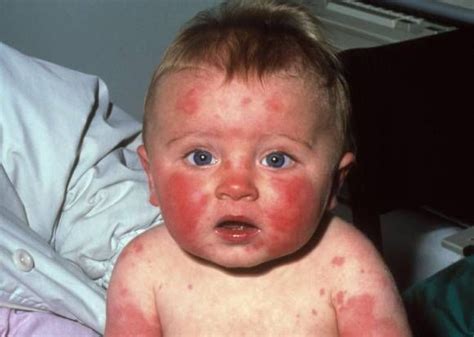 Visual guide to children's rashes and skin conditions | Fifth disease, Rash treatment, Eczema ...