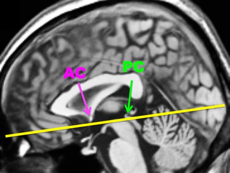 Anterior Commissure Mri