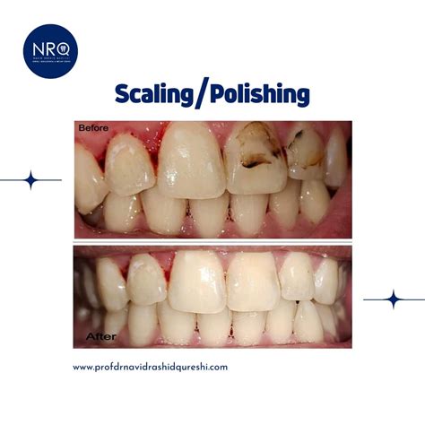 Scaling /Polishing - Drprofnavidqureshi - Medium