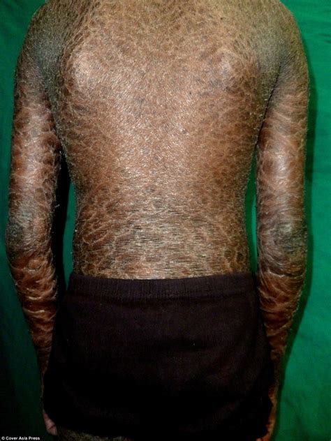 Effiong Eton: Rare Skin Disease Leaves Brother and Sister with SCALES all Over Their Bodies