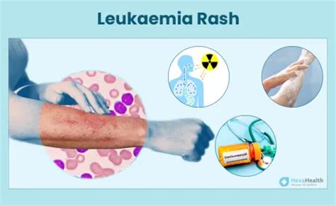 Leukemia Rash - Early Stage Pictures, Causes, Treatment