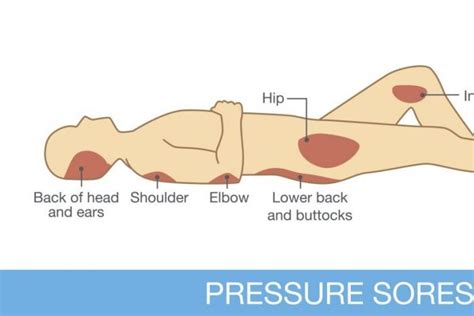 Top 10 Questions About Pressure Sores - Health & Detox & Vitamins