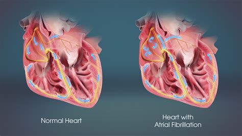 Atrial Fibrillation & Related Cardiac Risks - Scientific Animations