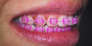 10 colored pink braces for charming teenage girls | Braces Explained