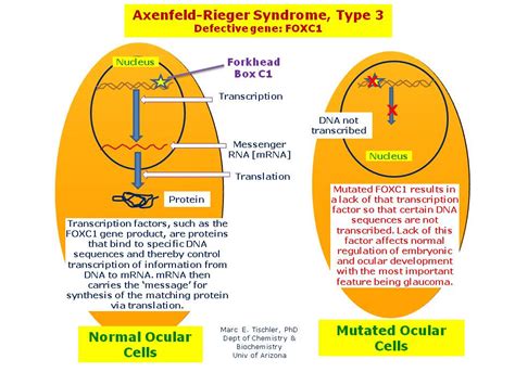 Axenfeld-Rieger Syndrome, Type 3 | Hereditary Ocular Diseases