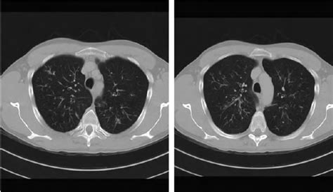 CT scan showing ‘ tree in bud ’ aspect in both lungs. | Research Image