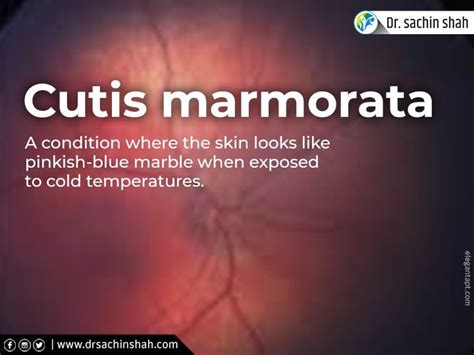 #Newborn baby #skin conditions : Cutis marmorata | Conditioner, Skin ...