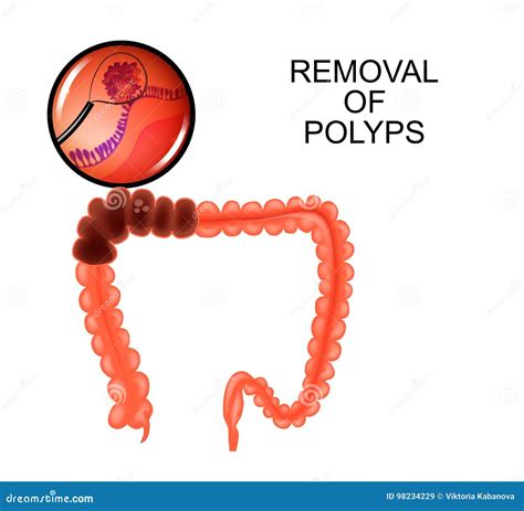 Polyps in the Colon. Removal of Polyps Stock Vector - Illustration of ...