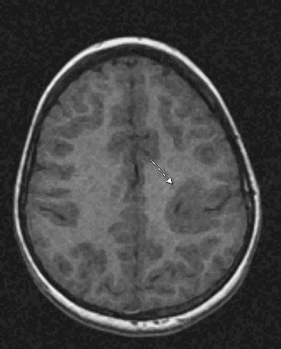 Cortical Dysplasia-MRI - Sumer's Radiology Blog